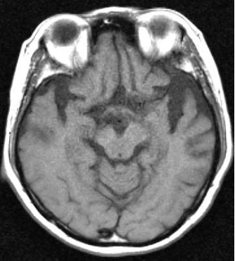意味性認知症の頭部MRI