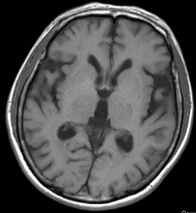 アルツハイマー型認知症の頭部MRI