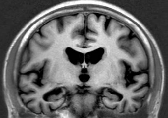 アルツハイマー型認知症の頭部MRI