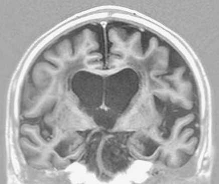 ビンスワンガー型血管性認知症の頭部MRI