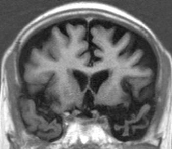 意味性認知症の頭部MRI