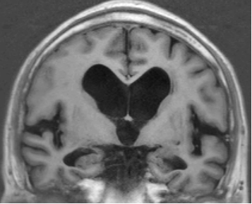 正常圧水頭症の頭部MRI